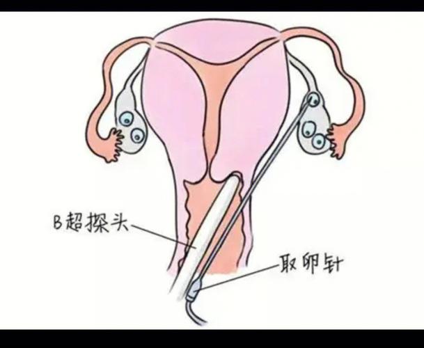 取卵刺激