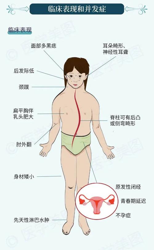 特纳综合征