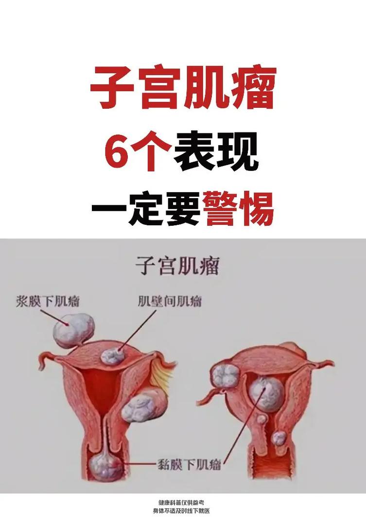 子宫肌瘤