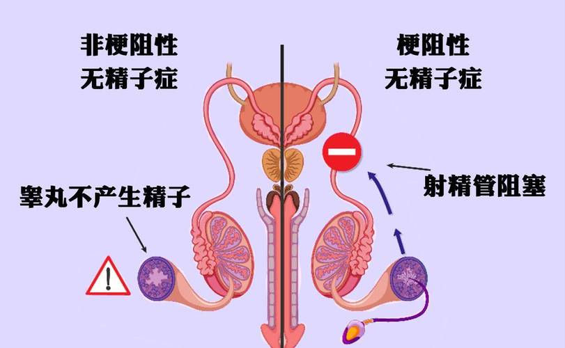 梗阻性无精子症