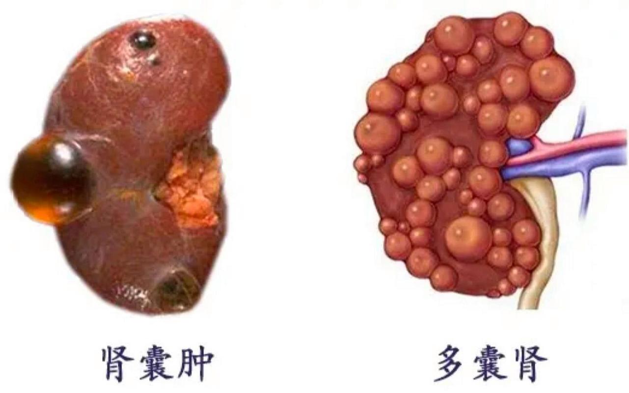 肾囊肿