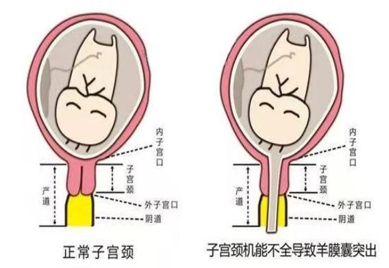 宫颈长度