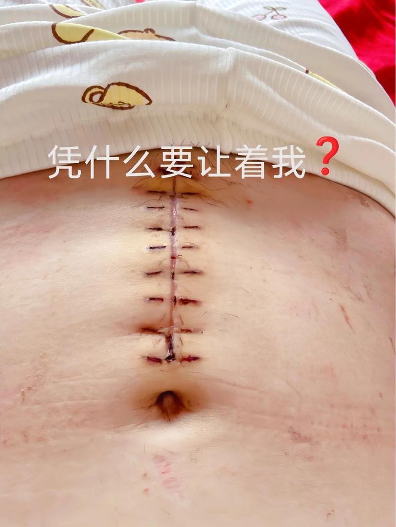 剖腹产