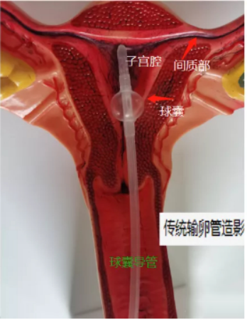 无输卵管