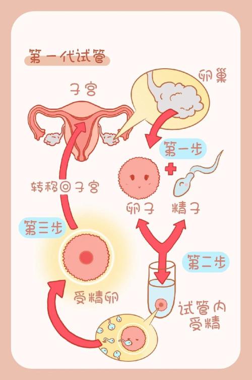 第一代试管婴儿