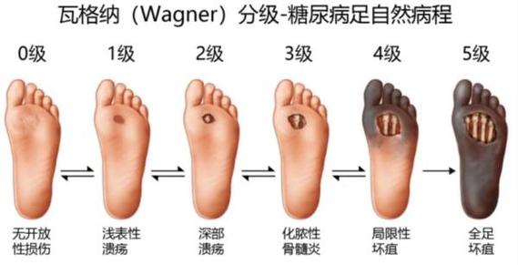  截肢风险