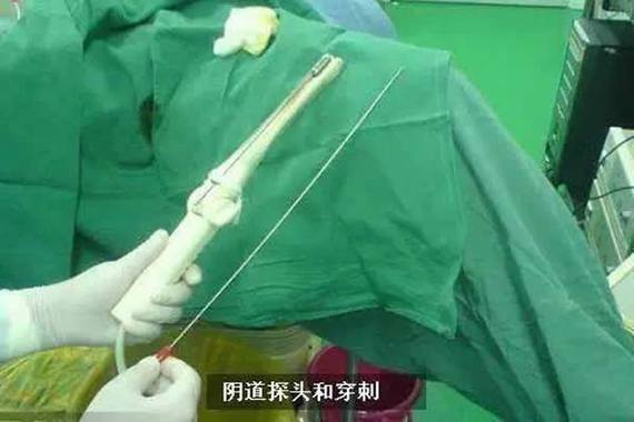 取卵时如何确保获得最佳卵泡？