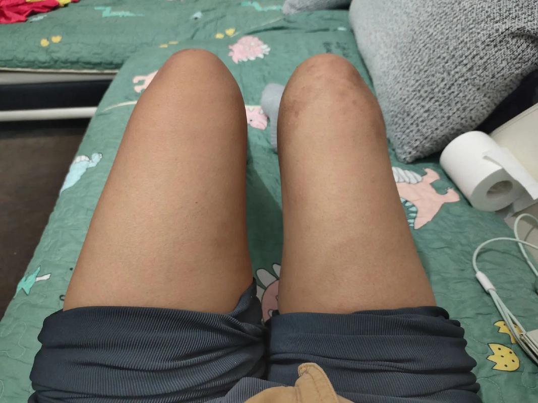 肌肉萎缩