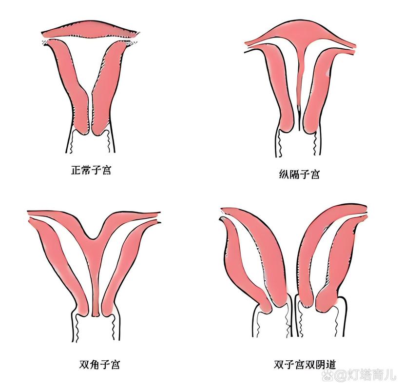 子宫羊角状
