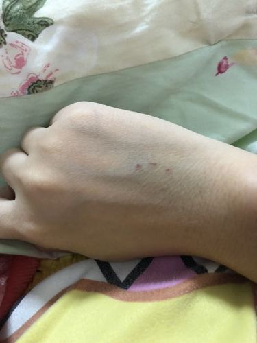 试管婴儿过程中的针孔疼痛如何缓解？