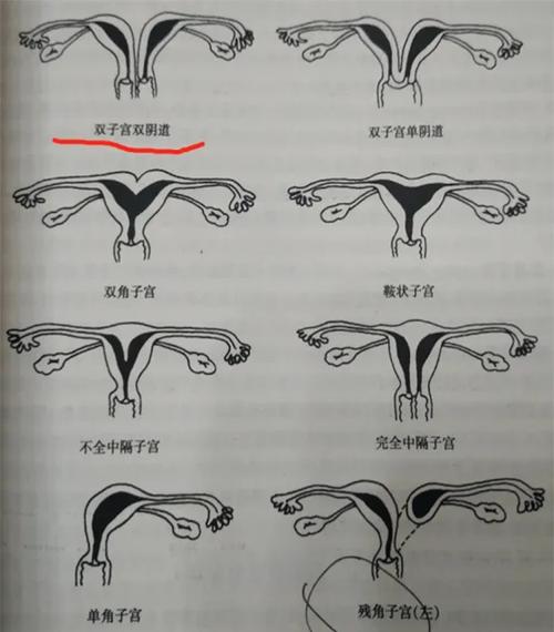 子宫双角症还能做试管婴儿吗？