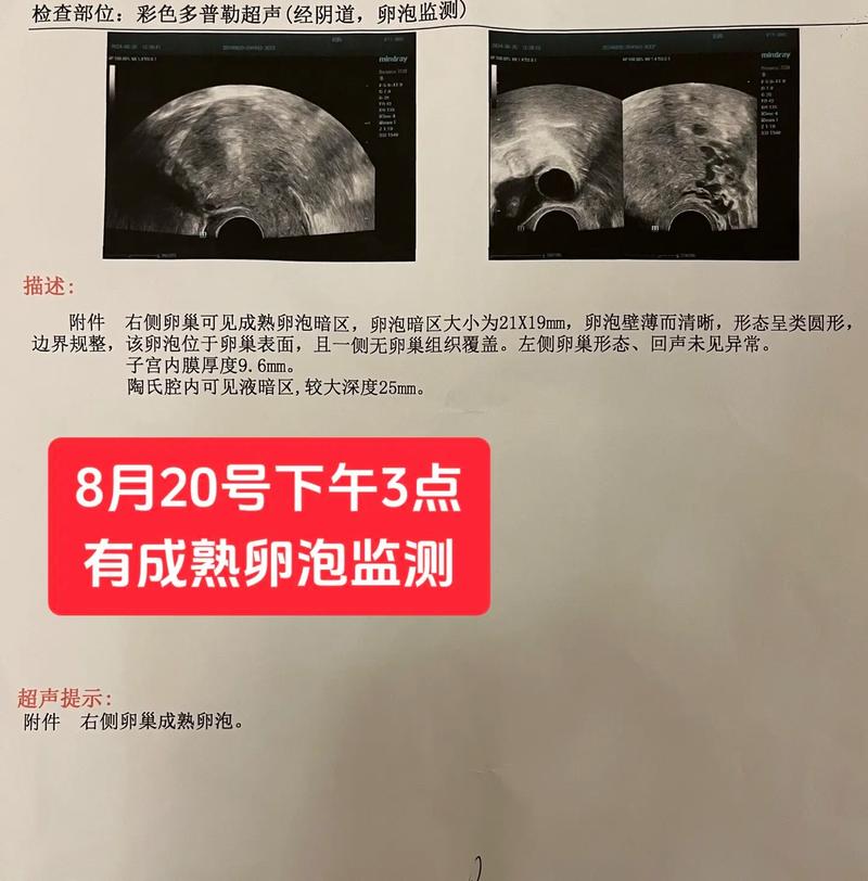  卵巢监测