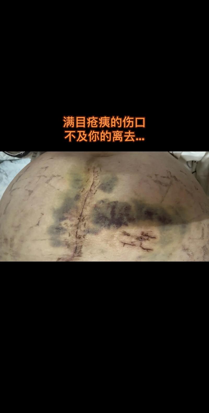  妊娠并发症