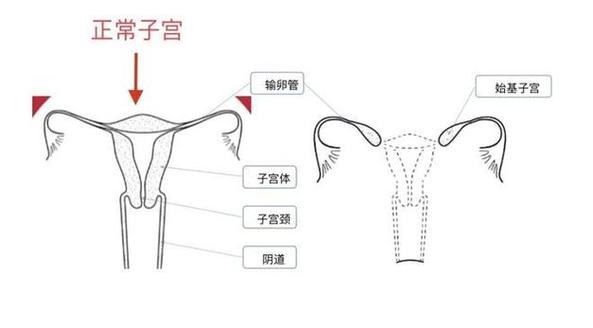 体外子宫