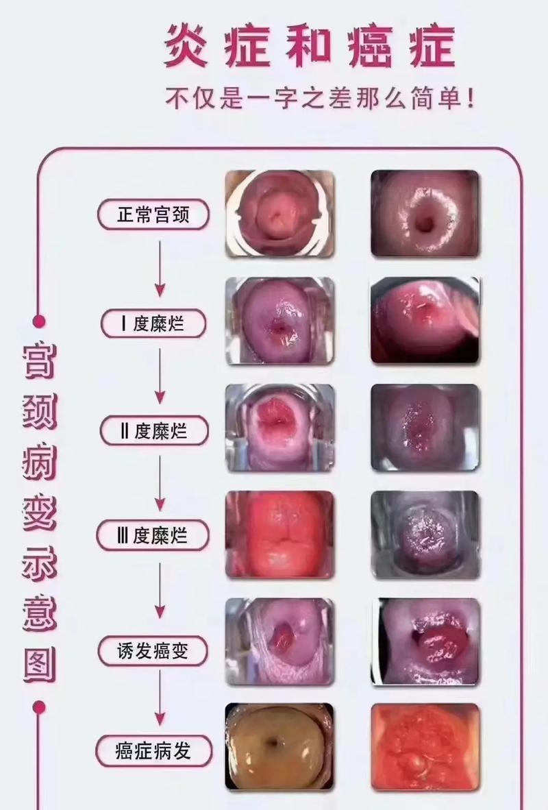 宫颈状况