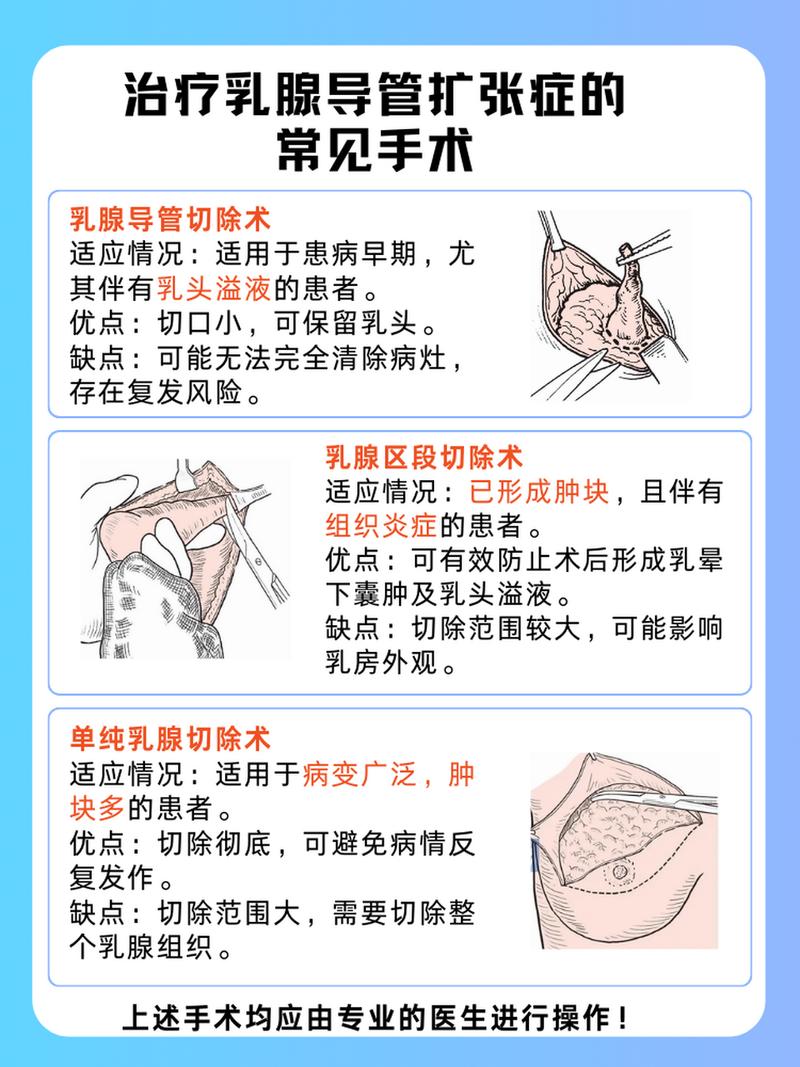 乳腺导管扩张
