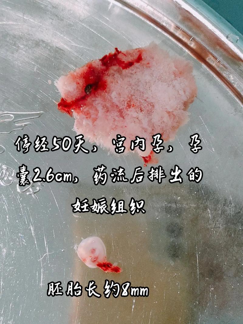  胚胎捐赠