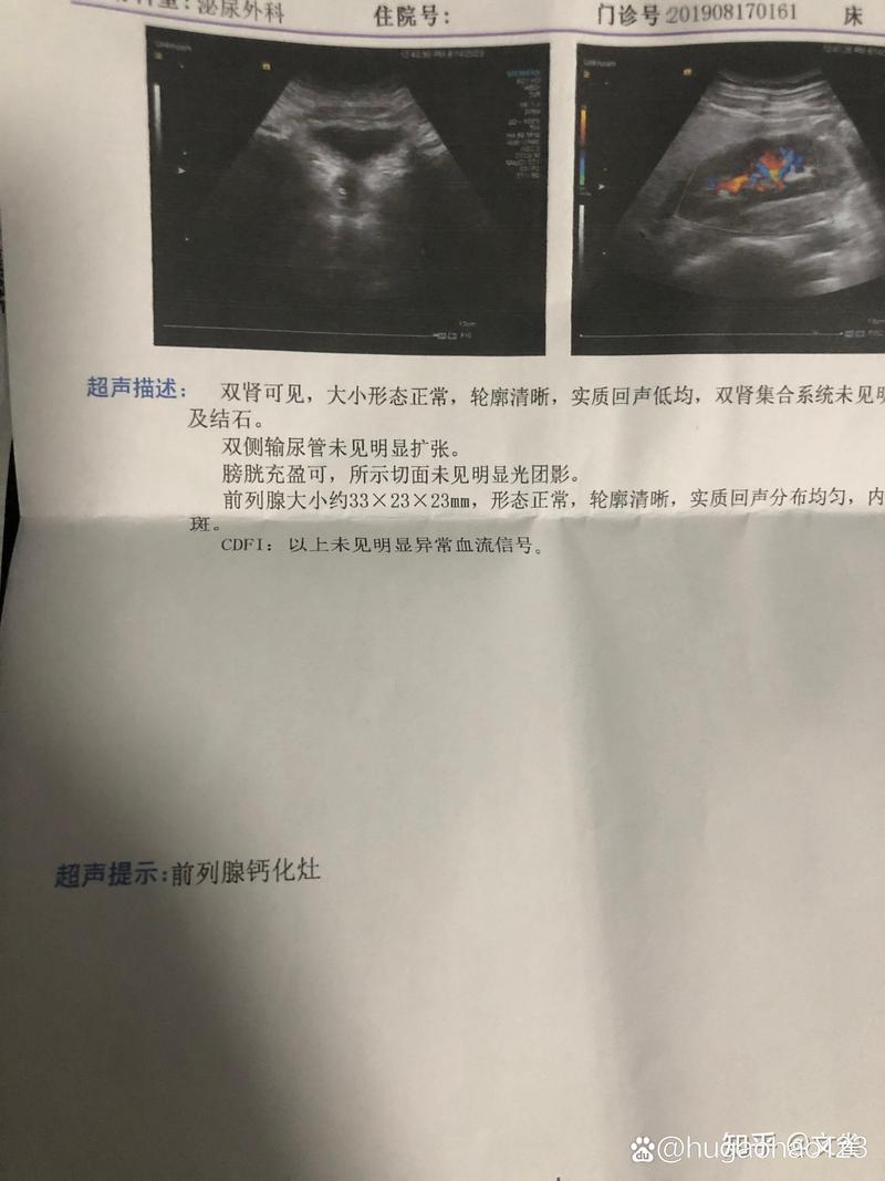 慢性附睾炎