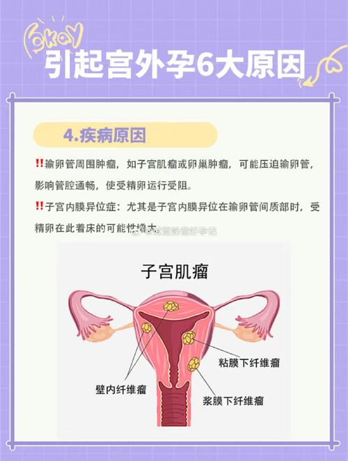 宫外孕
描述: 本文详细介绍了试管婴儿与卵巢妊娠风险之间的关联，分析了导致卵巢妊娠风险增加的因素，如年龄、输卵管疾病等，阐述了卵巢妊娠的后果，并讲述了预防和处理方法，为有相关需求的家庭提供参考 。