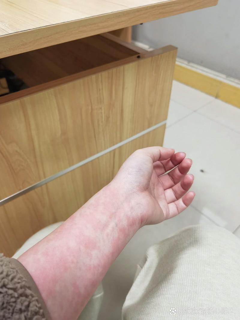 药物过敏