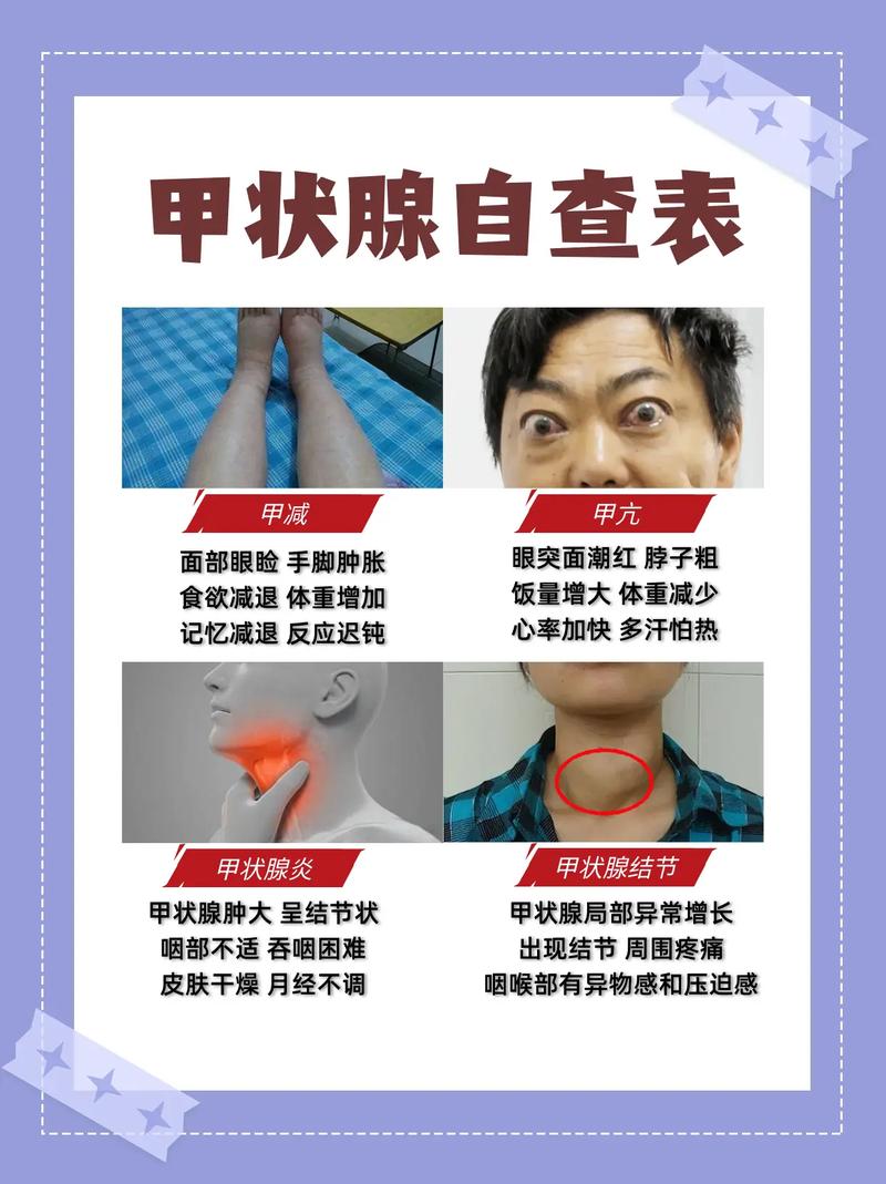 甲状腺疾病