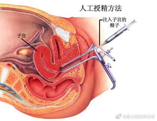 试管婴儿如何成功植入子宫内？