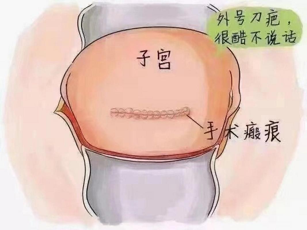 子宫疤痕