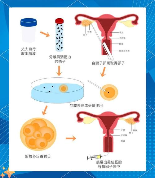 试管婴儿如何选择男孩女孩？