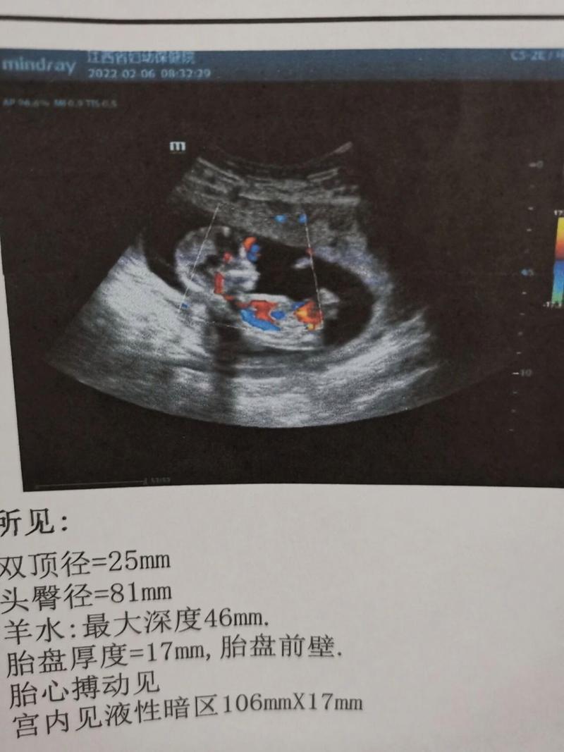  怀孕11-14周