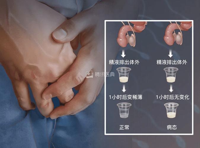 睾丸取精