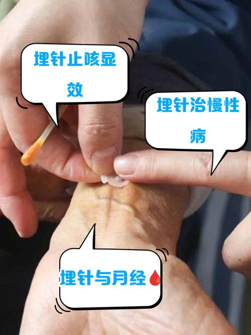 埋针