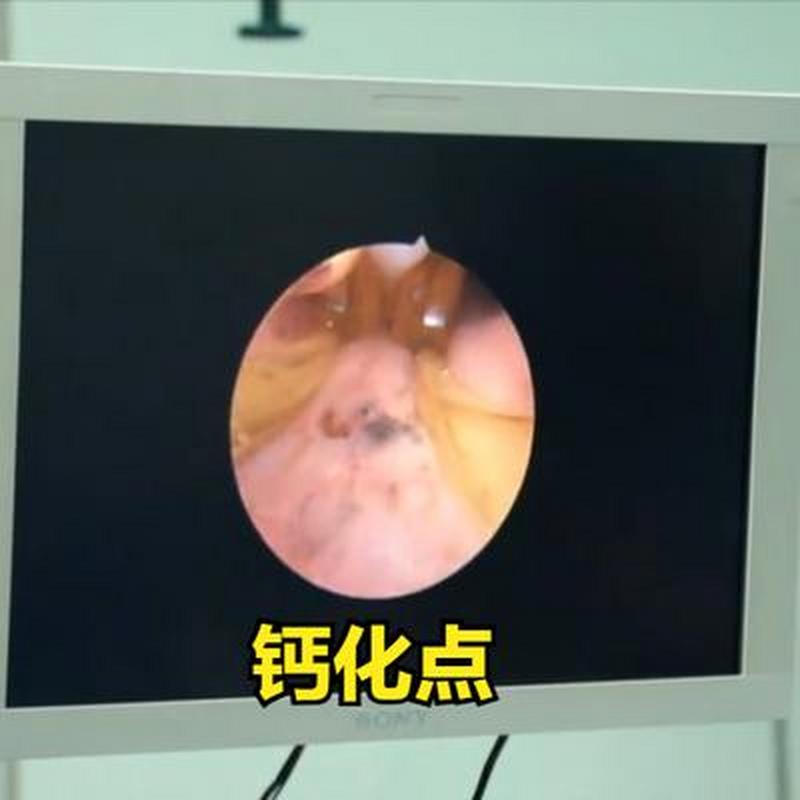 前列腺钙化