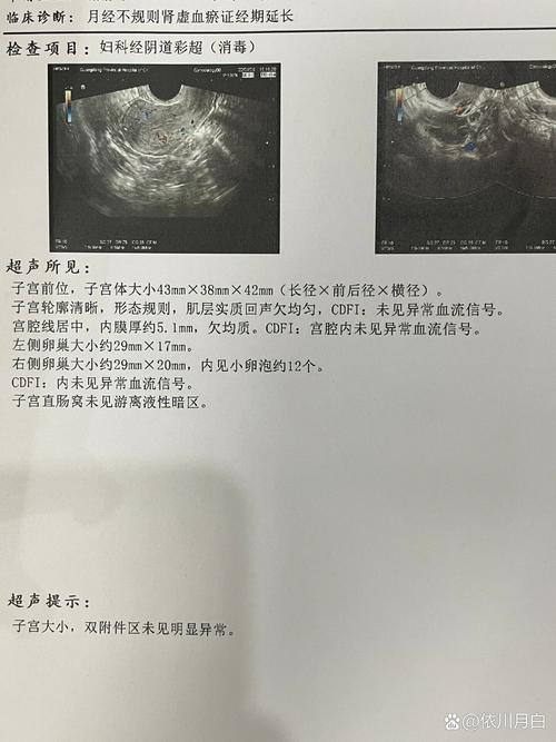 子宫内膜检查