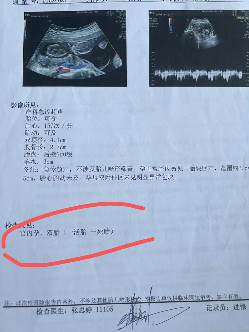 胎心消失
