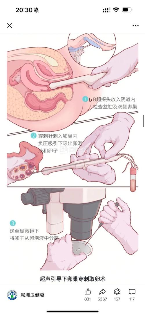 安全取卵
