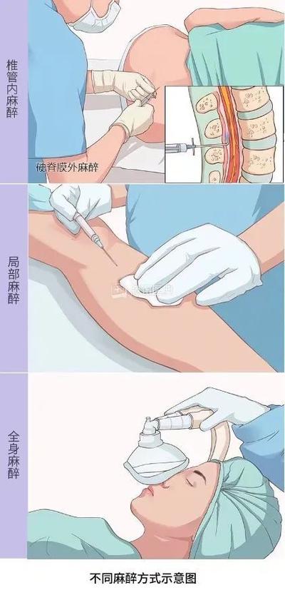 局部麻醉