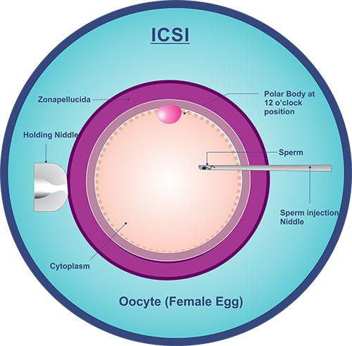  IVF-ICSI