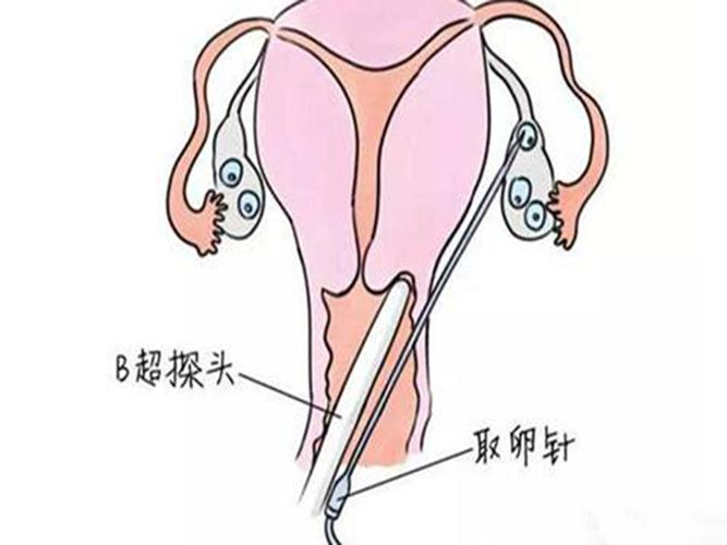 试管婴儿为何需要穿刺手术？