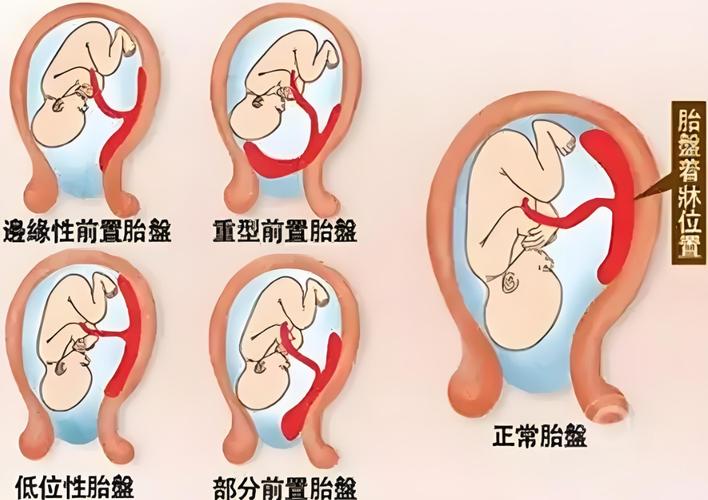 胎盘异常