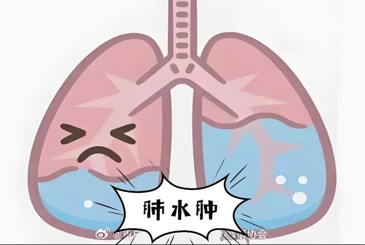 肺水肿