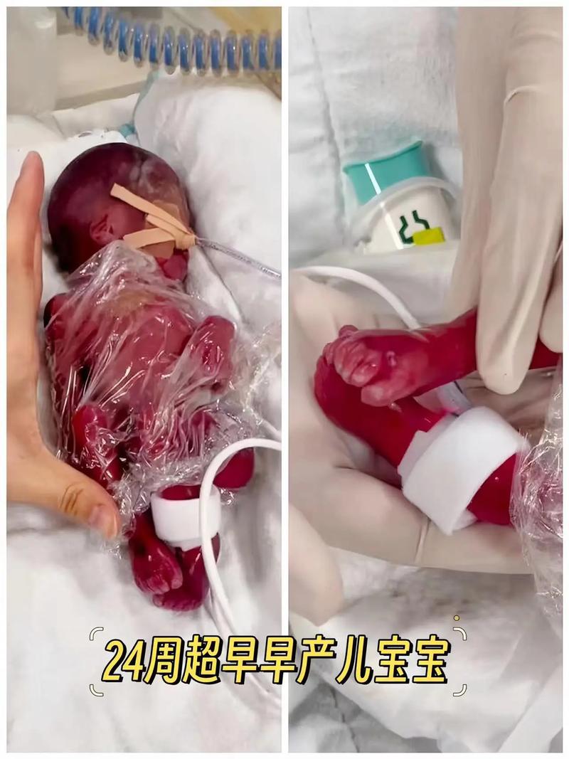早产儿