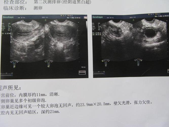 基础卵泡监测