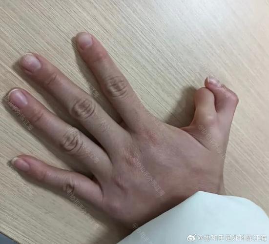 多拇指