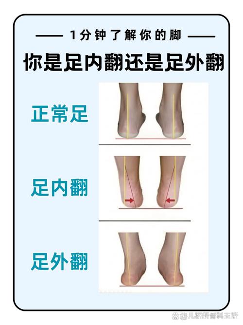  足内翻