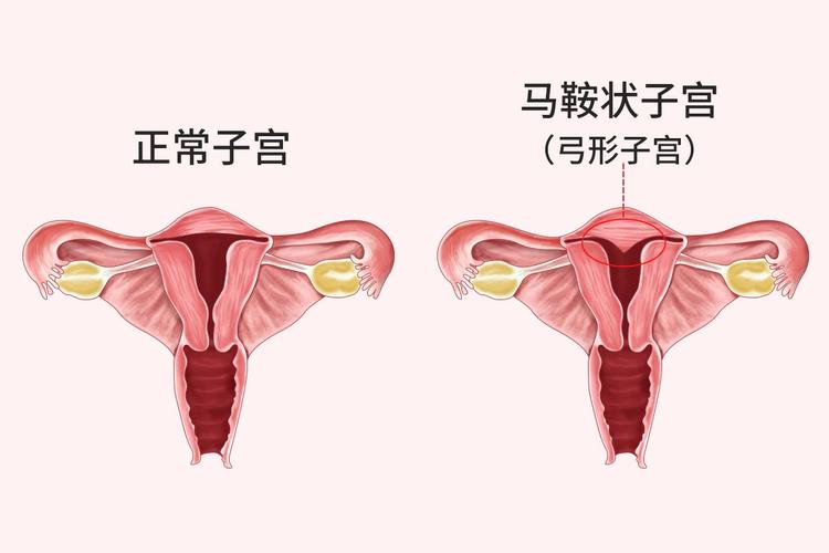 鞍形子宫