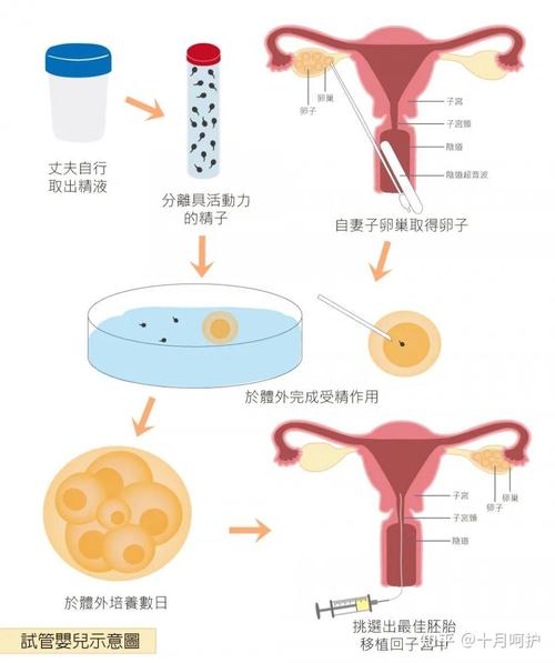 试管婴儿操作过程