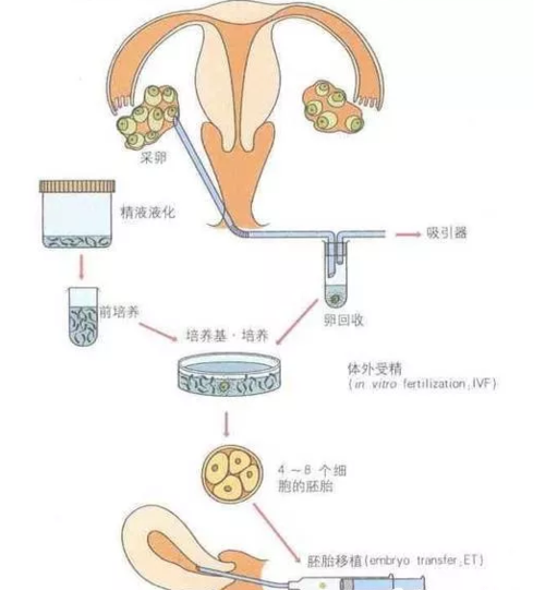 人工试管婴儿流程