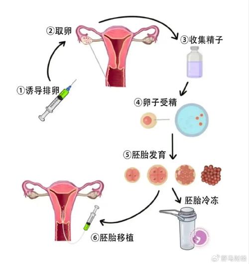 排卵移植技术