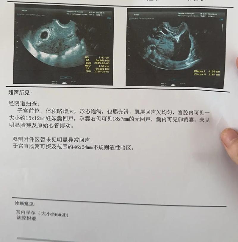 未见胎心