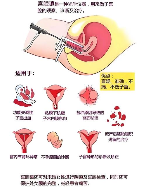宫腔镜